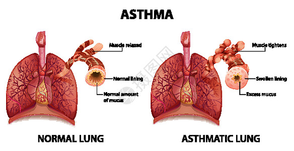健康肺与哮喘肺的比较图表海报生理科学器官哮喘病卡通片绘画药品疾病图片