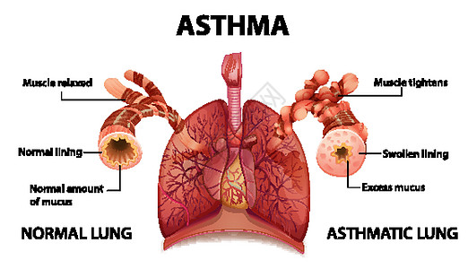 人体解剖学哮喘图生物学学习微生物学疾病生物信息药品哮喘病x光生活图片