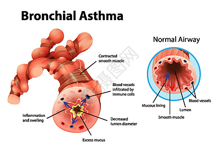 哮喘发炎的支气管管解剖学生理科学药品微生物学海报疾病船只插图图表图片