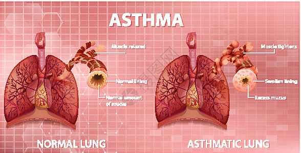 健康肺与哮喘肺的比较信息教育生物学器官科学哮喘病管子绘画身体支气管图片