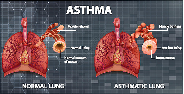健康肺与哮喘肺的比较哮喘病药品x光器官海报微生物学学习绘画疾病生物学图片
