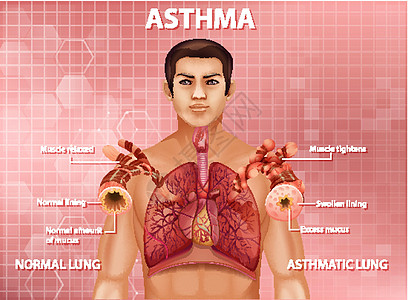 人体解剖学哮喘图生理病理管子哮喘信息生活学习疾病插图绘画图片