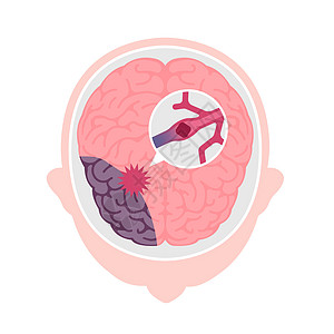 人脑中风的类型矢量图脑梗塞大脑静脉心血管信息船只警告脑血管解剖学攻击压力图片