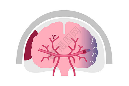 人类脑中中风病媒说明类型动脉静脉疼痛图表脑血管疾病脑梗塞攻击信息科学图片