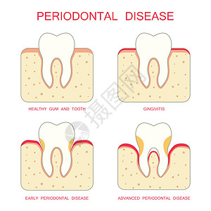 牙齿牙周病图片