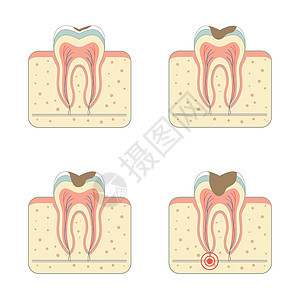 蛀牙病牙疼牙周解剖学疾病脓肿搪瓷运河牙齿疼痛牙科图片
