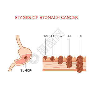 胃癌分期图片