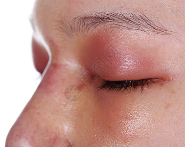 鼻子手术后上眼盖子肿胀的缝合身体感染女性女孩皮肤眼皮圆圈伤口工作睫毛图片