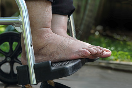 老年妇女在轮椅上进行高肿脚的体压测试脚肿照顾者女士祖母保健糖尿病药品皮肤女儿点蚀图片