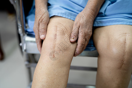 清洗伤口亚洲老年或老年老太太妇女病人在护理医院病房的床上展示她的疤痕手术全膝关节置换缝合伤口手术关节成形术 健康强大的医疗理念女性疼痛金背景
