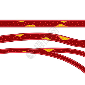胆固醇斑块它制作图案的载体营养高血压插图攻击血小板标识安全动脉糖尿病水果图片