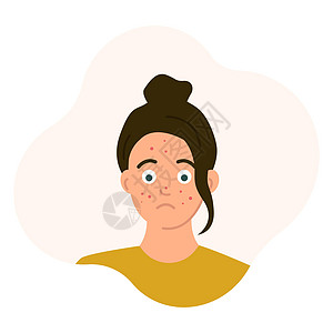 悲伤的少女脸上长着青春痘过渡期问题皮疹 在白色背景上隔离的平面样式中的矢量插图图片