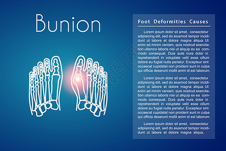 脚部矢量背景中的拇囊炎x光疼痛跖骨骨骼痛苦外翻药品骨科疗法科学图片