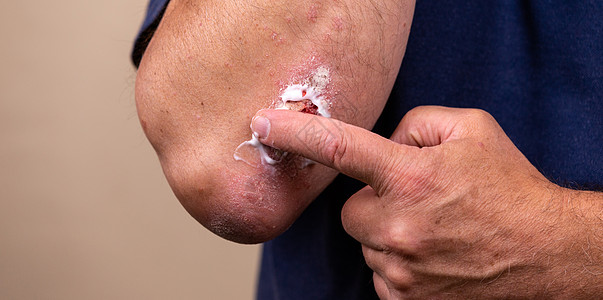 使用软膏作为药物剂型治疗皮肤病的概念照片 患者在肘部区域特写的皮肤上引起医疗软膏稠度或乳霜保湿剂图片