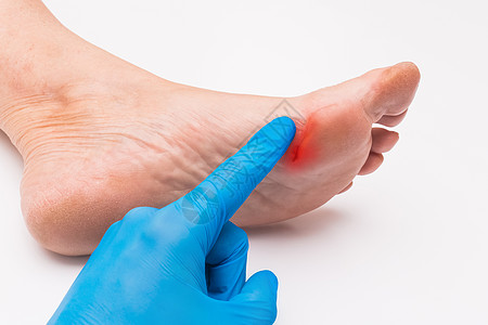 清洗伤口一名医生的手戴着防护性医用手套 用手指触摸他的手 检查一位白色背景的老妇人脚上的伤口 医疗理念背景
