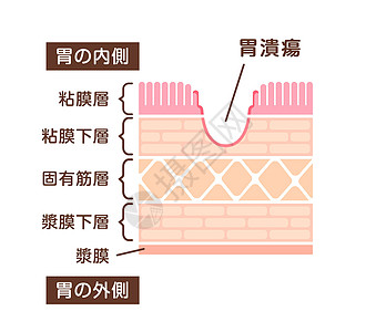 胃溃疡的分区视图插图侵蚀疼痛外科横截面癌症图表生物学溃疡浆膜身体图片