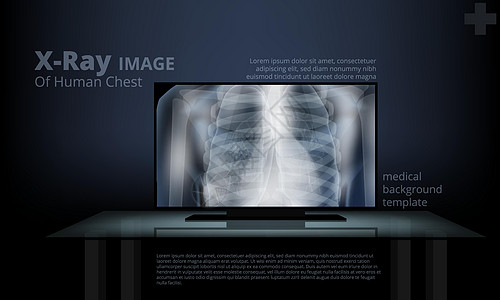 计算机屏幕上的X光人类胸透图像图片