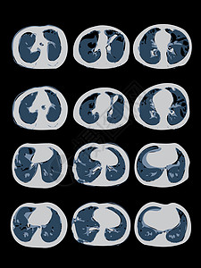 Covid-19 计算肺部地形图 CT扫描背景图片