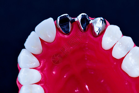 植牙和安装树冠工艺程序医生植入物手术牙科牙龈口服治疗教学蓝色药品图片