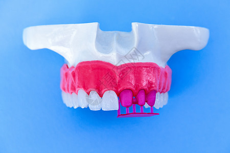 植牙和安装树冠工艺程序治疗诊所手术外科磨牙矫正牙科卫生医生牙齿图片
