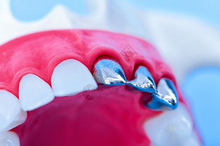 植牙和安装树冠工艺程序磨牙医生外科卫生手术假肢牙龈口服治疗技术图片