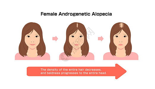 女性多生性活性地变异体发育进展 矢量插图卫生疾病解决方案雄激素压力症状发型毛囊图表女士图片
