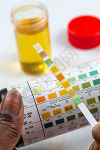 内尿自测试自计量封闭视图静物自测小瓶尿检分析葡萄糖医学测试宏观红细胞图片