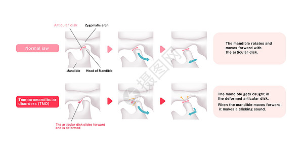 正常下巴和疾病TMD比较图药品骨骼骨头解剖学关节盘颅骨外科机能科学牙科图片