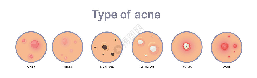 痤疮的概念 痤疮的类型 丘疹 结节 黑头粉刺 白头粉刺 脓疱 囊性扁平病媒图解背景图片