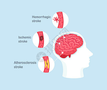 人类脑中风类型 缺血 无眼硬化和出血性中风疾病中风卫生静脉保健压力血管科学细胞图表病人图片