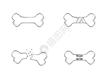 骨折固定板 螺丝 指甲 棒 愈合骨矢量说明 解剖图象图片
