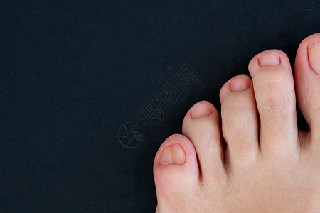 黑背景上双脚大脚尖的女子脚手指缺陷小指修脚创伤女士医疗先天脚趾赤脚图片