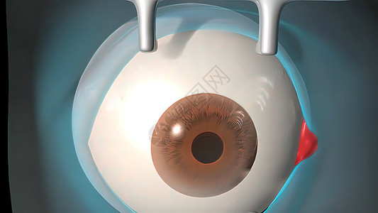 白内障手术应用观察外科手术对人眼的观察眼球自然病人医生皮层超声视网膜眼睛胶囊萃取背景图片