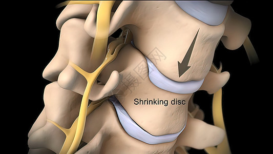 中央圆盘伸缩顶视图椎骨治疗血管疗法身体外科脊柱神经药品男人背景图片