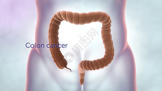 在肠道或肠道癌肿瘤可见的肠透镜检查中 结肠结肠癌癌症病理细胞诊断研究外科组织消化疼痛直肠图片