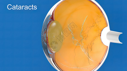 白内障 蒙上眼睛的透镜 导致视力下降横截面胶囊外科眼镜巩膜医院超声折射显微镜鸢尾花图片