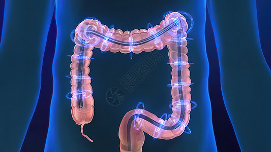 人类消化系统 3D 结肠镜检查程序插图预防诊断冒号病理监视器检测内窥镜结肠炎动画检查背景图片