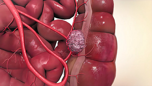 在结肠内发展的增长是给结肠命名的字眼诊断结肠炎反流科学附录直肠腹部冒号胃炎便秘背景图片