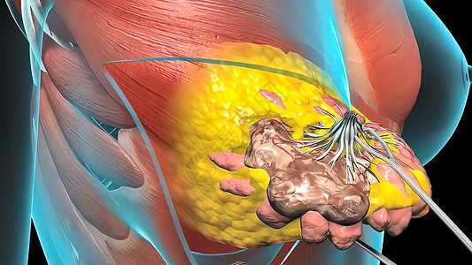 心脏肿瘤生长的外科手术乳腺医生身体插图腺体艺术品科学女性化疗水晶图片
