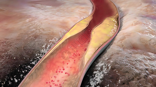 将动脉与石碑连在一起肥胖血管攻击科学牌匾医学压力疾病营养动脉粥样硬化背景图片