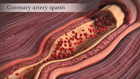 高血冠状动脉抽搐是这些动脉之一的短暂 突然缩小饮食细胞危险动脉粥样硬化心血管营养肥胖血块凝块医学背景