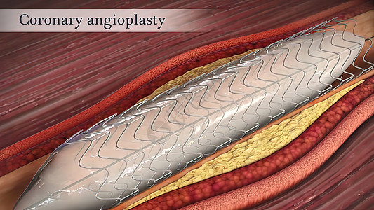 冠状血管成形器打开了较窄的冠状动脉动脉硬化危险动脉粥样硬化细胞封锁心脏病学医学压力疾病血块图片