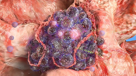 肿瘤发育阶段 3D医疗癌症细胞学化学生物学药品运动修辞格式微生物学球形图片