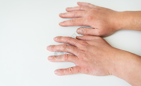 治疗皮肤病 牛皮癣 湿疹 皮炎 素质 在人的手上 皮肤病学方向的医学理念和治疗图片