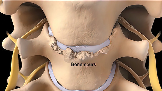 背面骨关节炎引起的关节损伤是骨刺的最常见原因解剖学治疗磁盘人体考试疗法身体鞭策运动软骨背景