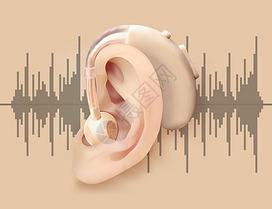 耳后数字助听器 在声波背景的耳朵和声音放大器 耳鼻喉科听力损失的治疗和修复 医学的现实向量例证图片