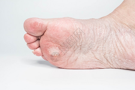 近身的雌女性脚部皮肤酸痛 干高跟鞋孤立在白色背景上疾病女孩脚趾皮肤科女性赤脚裂缝治疗女士疼痛图片