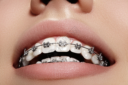 有牙套的美丽的白牙 牙科护理照片 女人微笑与矫形配饰品 整形治疗女孩美白嘴唇牙齿制品金属牙医宏观陶瓷口腔科图片