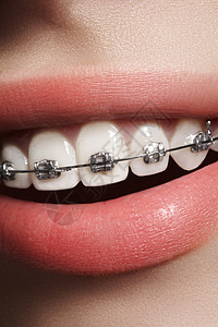 有牙套的美丽的白牙 牙科护理照片 女人微笑与矫形配饰品 整形治疗牙齿保健女性矫正女孩制品嘴唇女士牙医美白图片