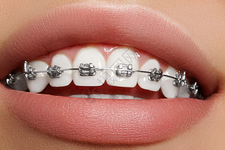 有牙套的美丽的白牙 牙科护理照片 女人微笑与矫形配饰品 整形治疗宏观喜悦矫正金属医生制品卫生牙医陶瓷快乐图片